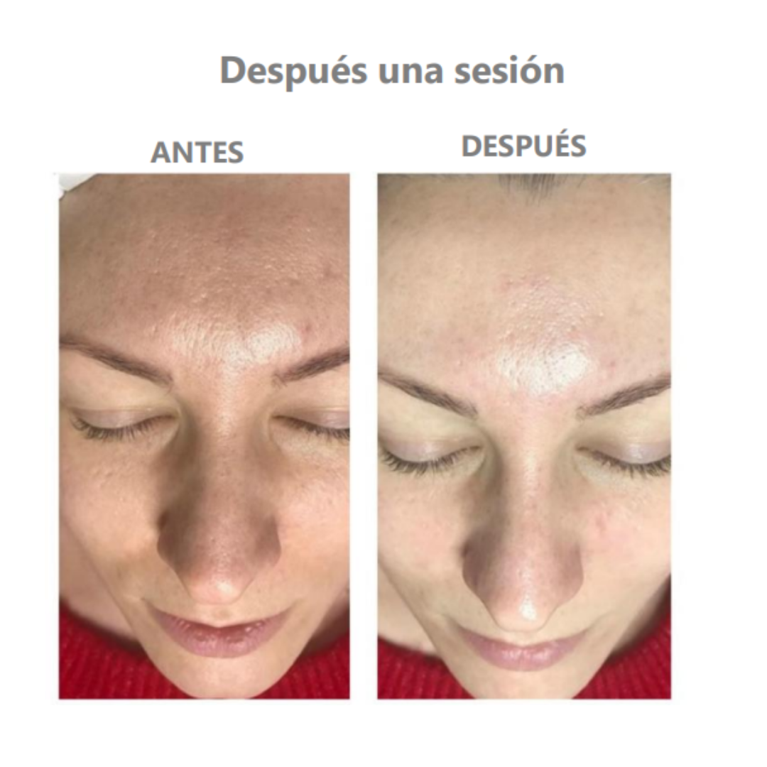 Type 1 Peel  de Cabina de Medical Cosmetics thumbnail