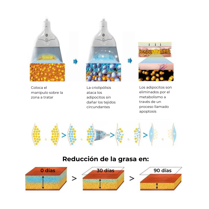 Criolipólisis RSCP 4 Manípulos W025: esquema o detalle de aplicación